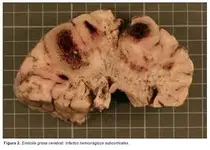 grasa en el cerebro....webp