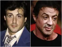 sylvester-stallone-plastic-surgery-3.webp